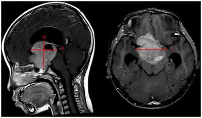The Visual Acuity Outcome and Relevant Factors Affecting Visual Improvement in Pediatric Sporadic Chiasmatic–Hypothalamic Glioma Patients Who Received Surgery